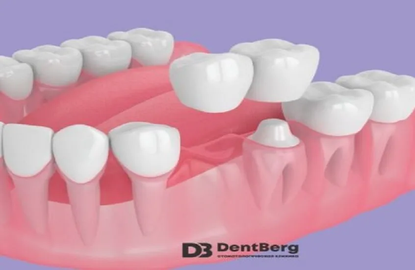 روسيا.. ابتكار بديل رخيص لزراعة الأسنان